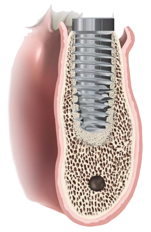 Ossedensification cut away showing the additive technique