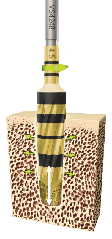 Osseodensification Motion