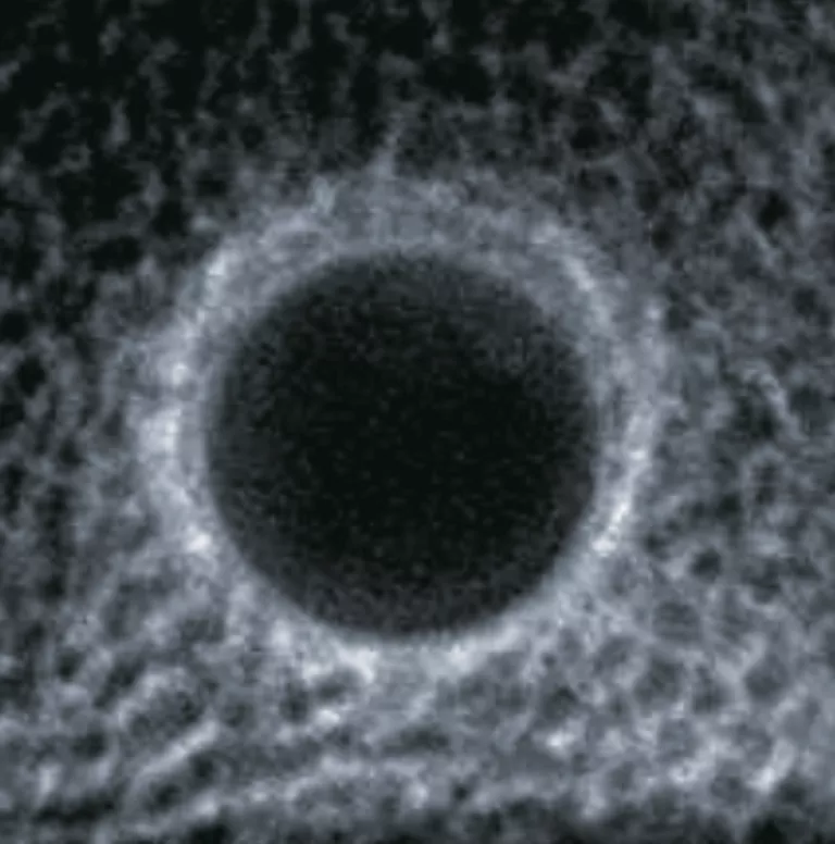 Actual Osseodensification Hole x-ray image