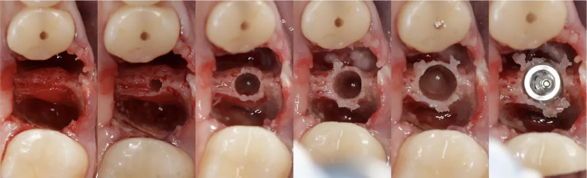 Osseodensification Molar Septum progression